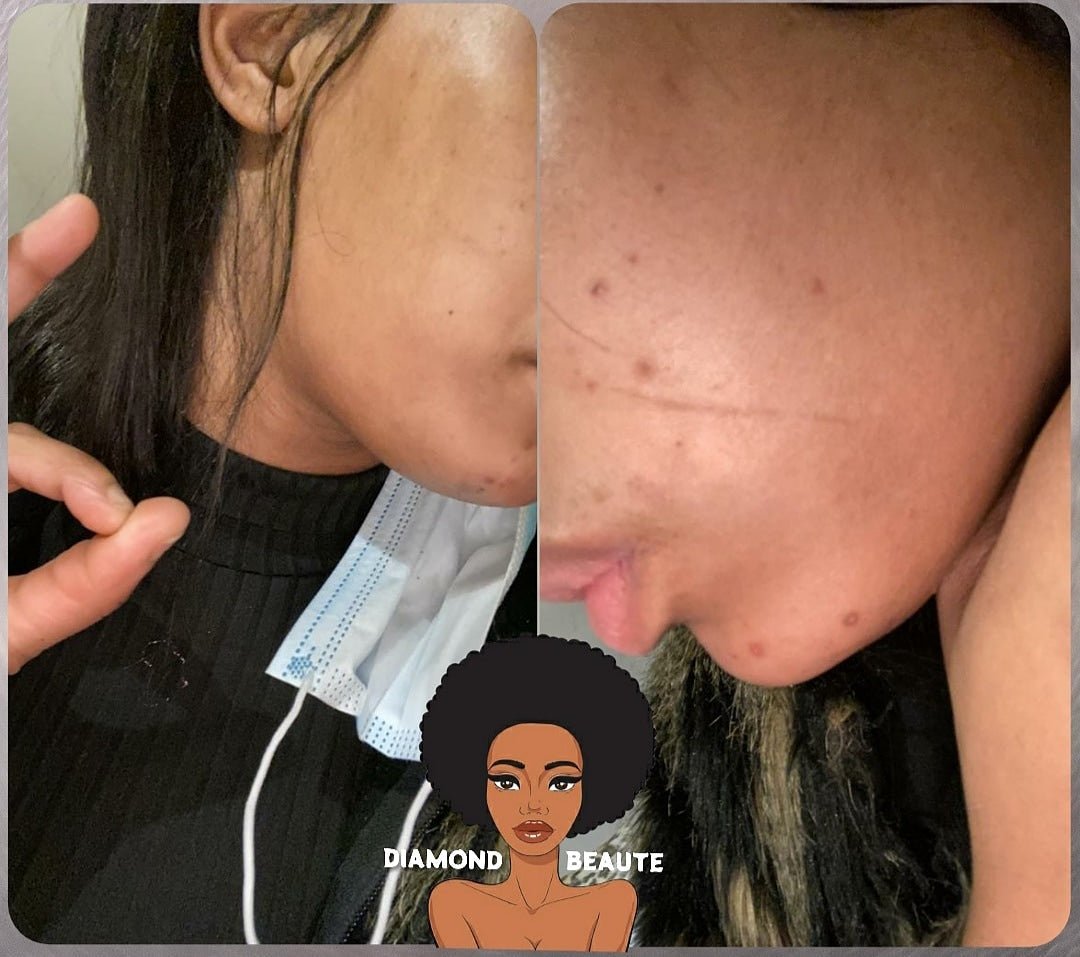 Traitement Acne- Dark spots remover - Diamond Beaute